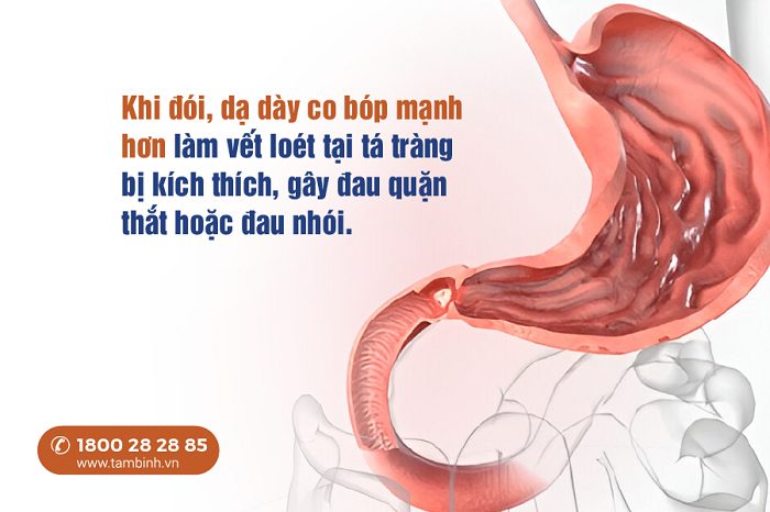 Tại sao loét tá tràng đau khi đói? 4 Cách giảm đau nhanh và an toàn