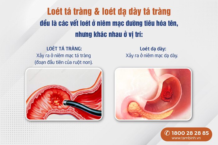 Tá tràng nằm ở đâu? Tìm hiểu vị trí, cấu tạo và chức năng tá tràng 