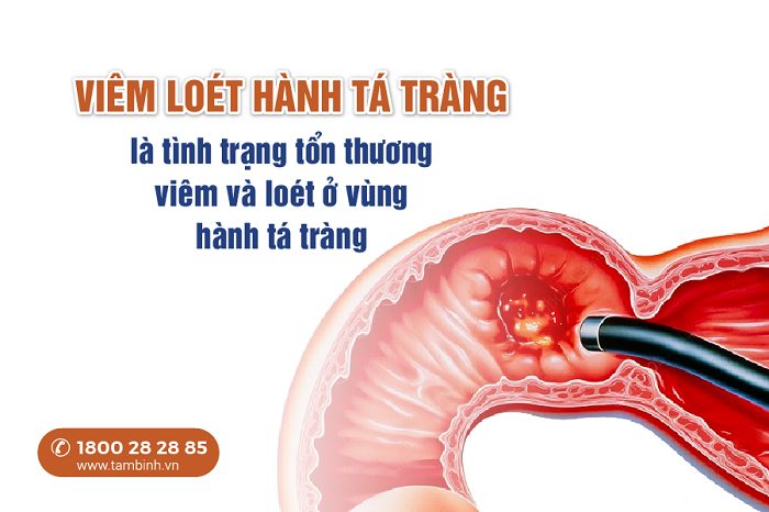 Viêm loét hành tá tràng có nguy hiểm không? Cách nhận biết và xử lý sớm