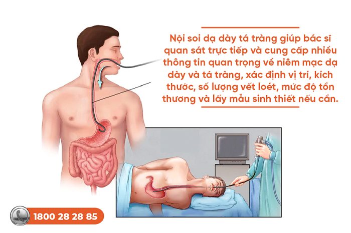 Viêm loét dạ dày tá tràng tự khỏi được không? Phác đồ điều trị chuẩn