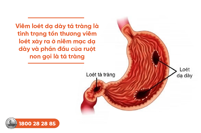 Viêm loét dạ dày tá tràng tự khỏi được không? Phác đồ điều trị chuẩn