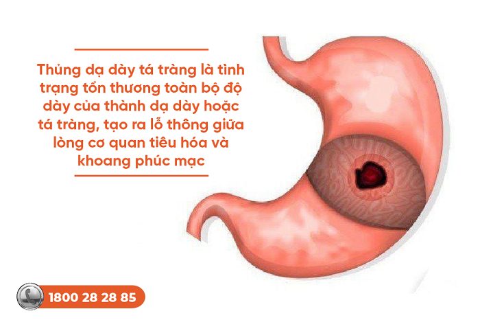 Thủng dạ dày tá tràng: Dấu hiệu nhận biết sớm và điều trị hiệu quả