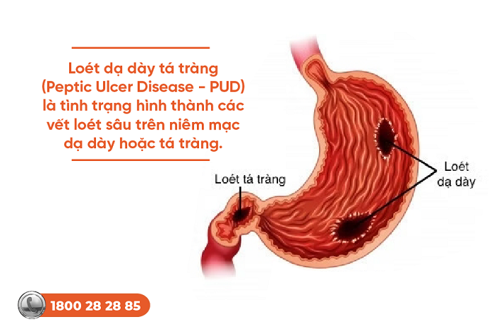 Cơ chế bệnh sinh của loét dạ dày tá tràng: Giải thích chi tiết từ chuyên gia