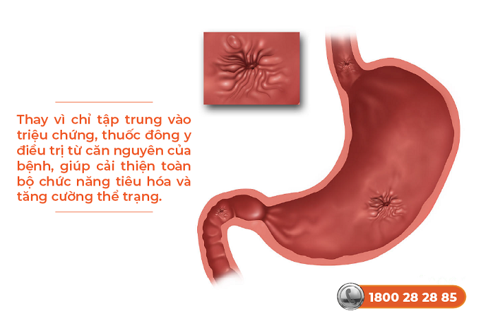 Bài thuốc Đông y trị viêm loét dạ dày: 8 công thức an toàn, hiệu quả!