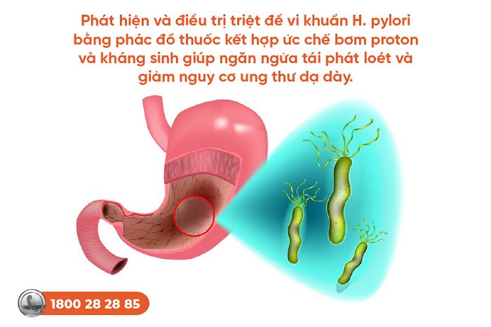 Cơ chế bệnh sinh của loét dạ dày tá tràng: Giải thích chi tiết từ chuyên gia